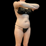 High Definition Liposuction Before & After Patient #13667
