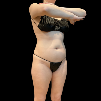 High Definition Liposuction Before & After Patient #13667