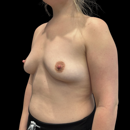 Breast Augmentation Before & After Patient #13669