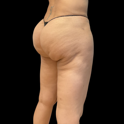Fat Transfer Before & After Patient #13670