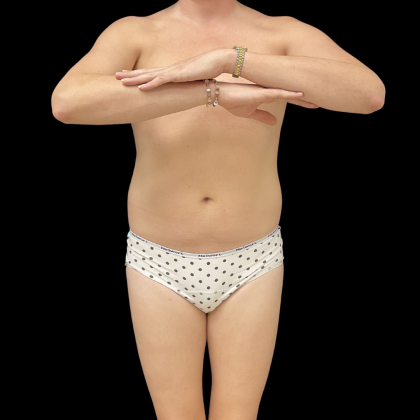 Rib Repositioning Before & After Patient #13675