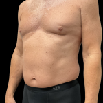 Liposuction Before & After Patient #13685
