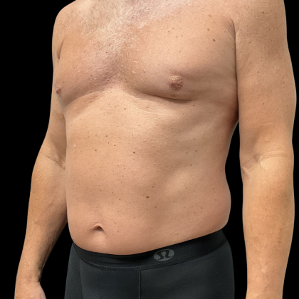 Liposuction Before & After Patient #13685