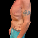 Tummy Tuck Before & After Patient #13683