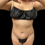 Liposuction Before & After Patient #13684