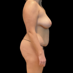 Tummy Tuck Before & After Patient #13686