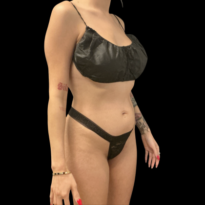 Brazilian Butt Lift Before & After Patient #14199