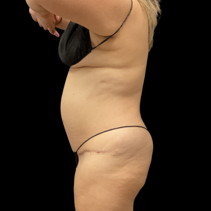 Brazilian Butt Lift Before & After Patient #13626