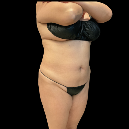 Brazilian Butt Lift Before & After Patient #13588