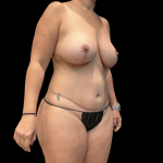 Mommy Makeover Before & After Patient #13589