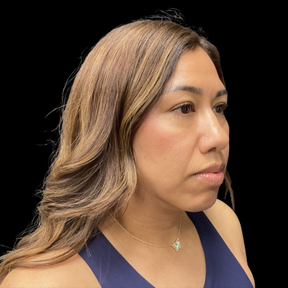MyEllevate Before & After Patient #13663