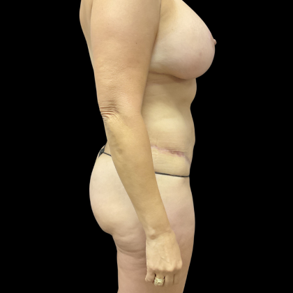 Mommy Makeover Before & After Patient #13665