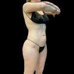 High Definition Liposuction Before & After Patient #13667