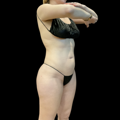 High Definition Liposuction Before & After Patient #13667