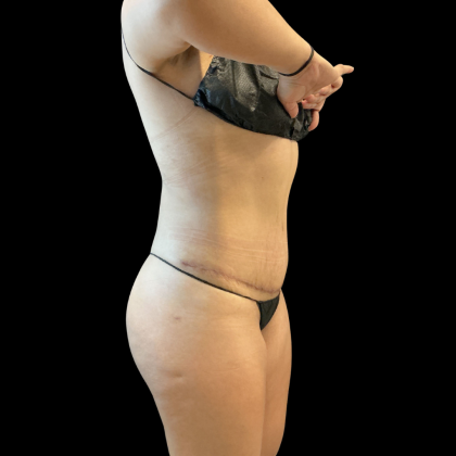 Tummy Tuck Before & After Patient #13666