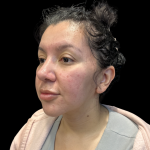 MyEllevate Before & After Patient #13624