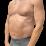 Liposuction Before & After Patient #13685