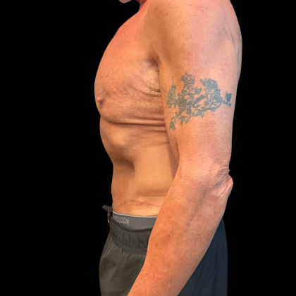 Tummy Tuck Before & After Patient #13683