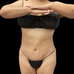 Liposuction Before & After Patient #13684