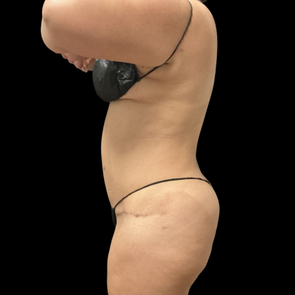 Brazilian Butt Lift Before & After Patient #13626
