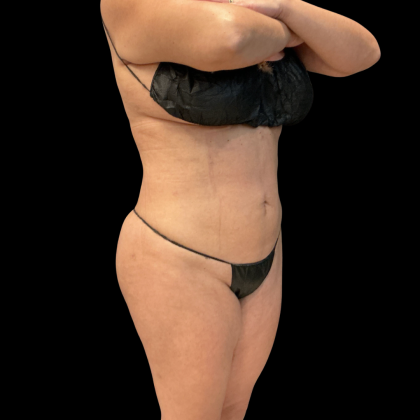 Brazilian Butt Lift Before & After Patient #13588