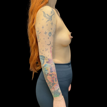 Breast Augmentation Before & After Patient #13660