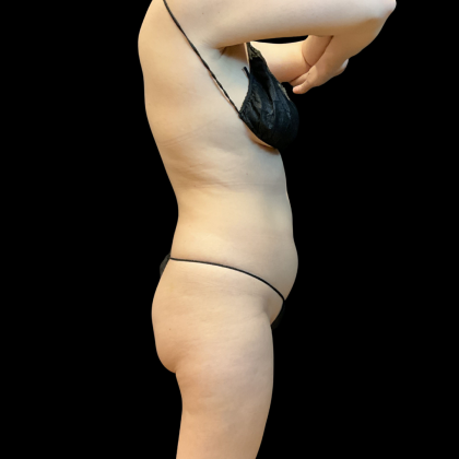 High Definition Liposuction Before & After Patient #13667