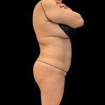 Brazilian Butt Lift Before & After Patient #13588