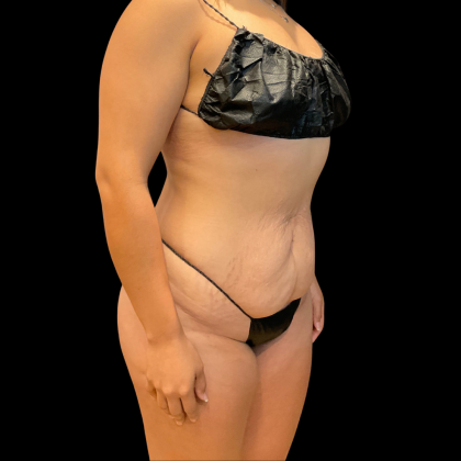 Tummy Tuck Before & After Patient #13666