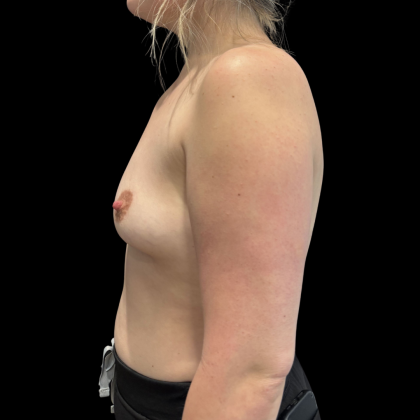 Breast Augmentation Before & After Patient #13669