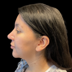 MyEllevate Before & After Patient #13624