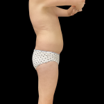 Rib Repositioning Before & After Patient #13675