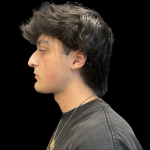 Liquid Rhinoplasty Before & After Patient #13676