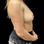 Breast Augmentation Before & After Patient #13678