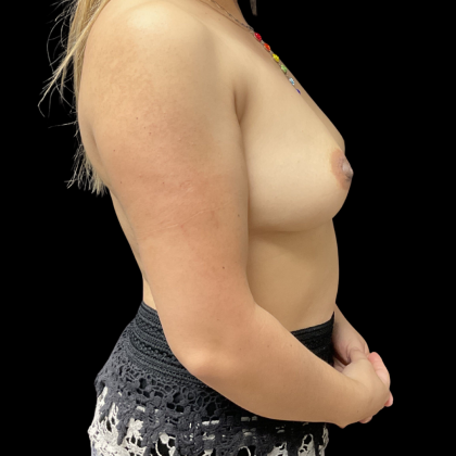 Breast Augmentation Before & After Patient #13678