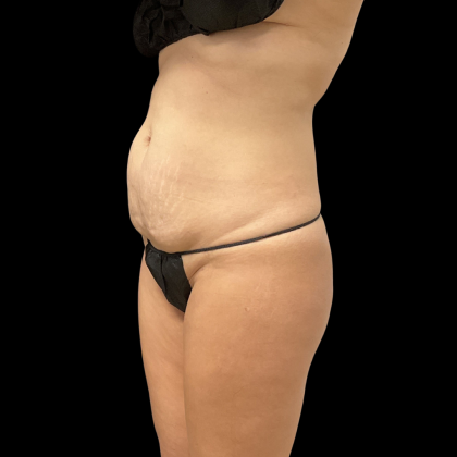 Fat Transfer Before & After Patient #13680