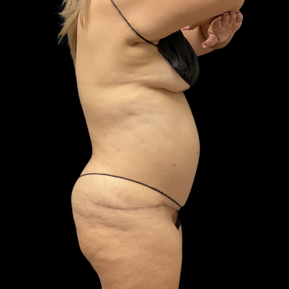 Brazilian Butt Lift Before & After Patient #13626