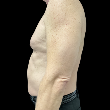 Liposuction Before & After Patient #13685
