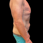 Tummy Tuck Before & After Patient #13683