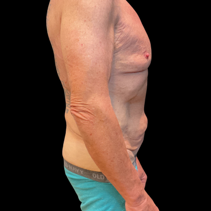 Tummy Tuck Before & After Patient #13683