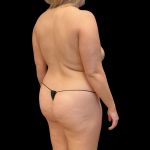 Tummy Tuck Before & After Patient #13686