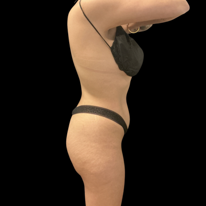Brazilian Butt Lift Before & After Patient #14199