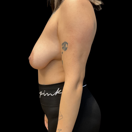 Mastopexy augmentation Before & After Patient #13657