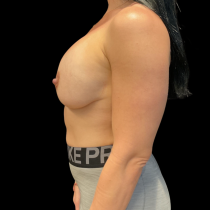 Breast Implant Exchange Before & After Patient #13658