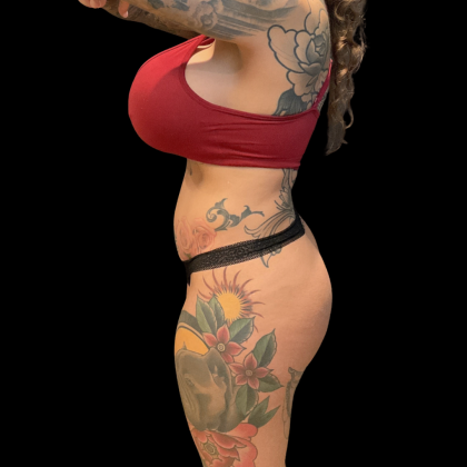 Butt Implants Before & After Patient #13659