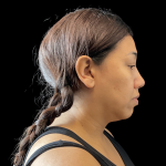 MyEllevate Before & After Patient #13663