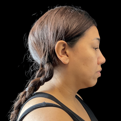 MyEllevate Before & After Patient #13663