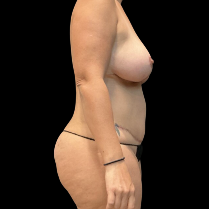 Mommy Makeover Before & After Patient #13589