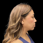 MyEllevate Before & After Patient #13663