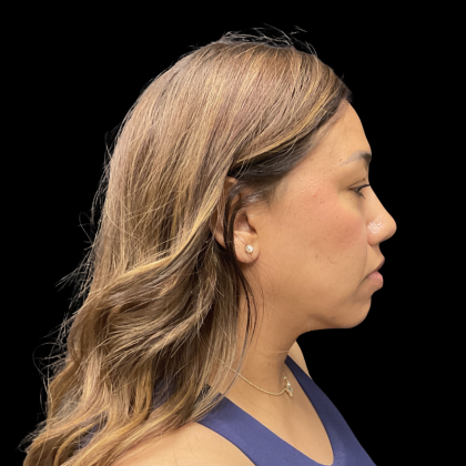 MyEllevate Before & After Patient #13663